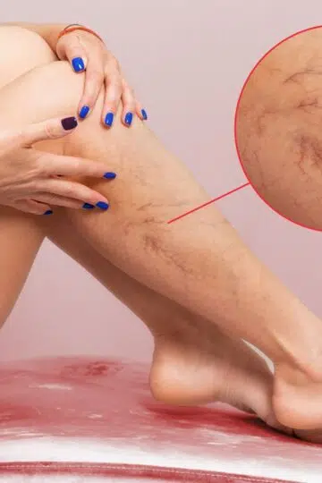🩺 Lemon Varicose Vein Natural Treatment